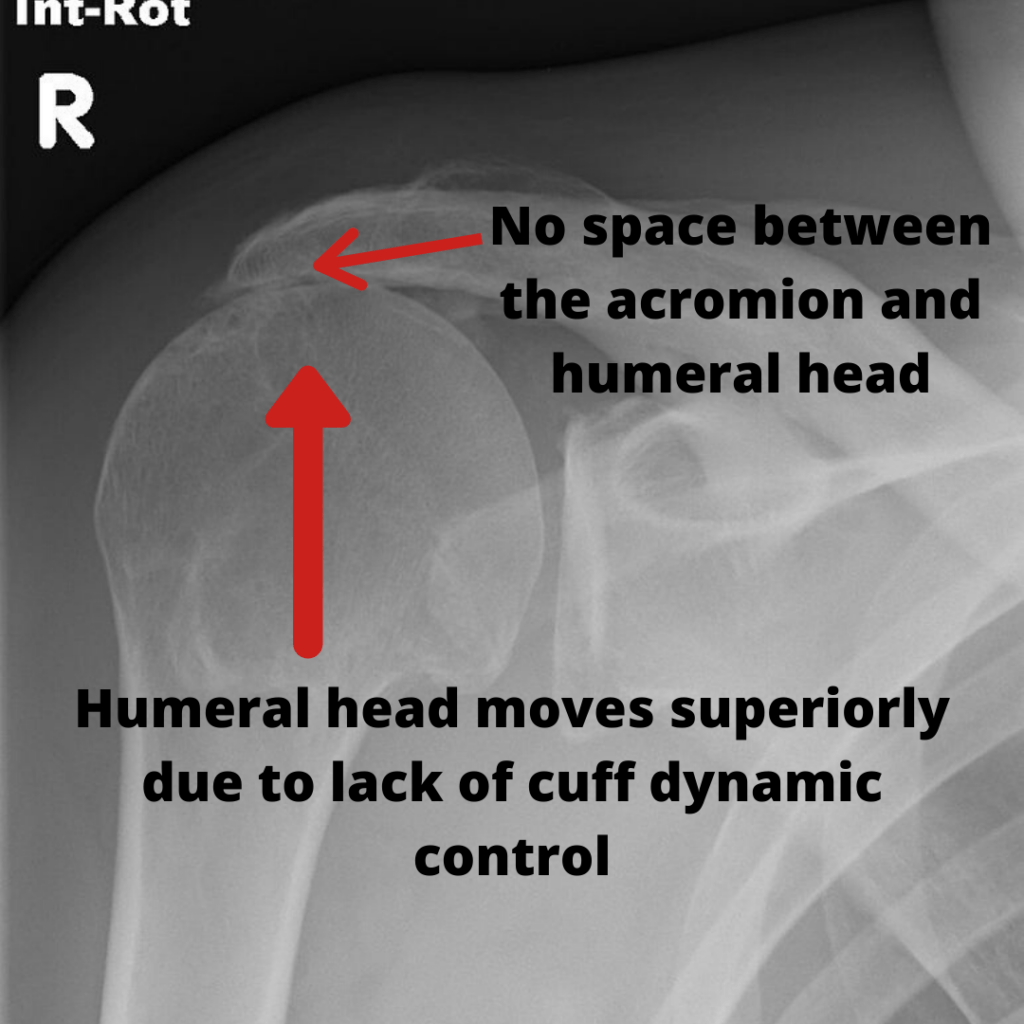 Complete Guide To Rotator Cuff Tears Tendinopathy And Subacromial